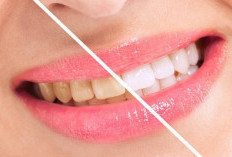 Tips Atasi Gigi Kuning dengan Buah! Untuk Senyum yang Lebih Percaya Diri