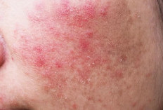 WAJIB DIINGAT! Jangan Gunakan Kandungan Skincare Ini Jika Kulit Iritasi