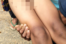 Kepala 'Burung' Bocah 9 Tahun di Kaur Nyaris Terpotong