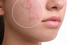 Bekas Jerawat Bikin Frustrasi, Ini Deretan Serum Ampuh yang Dapat Membasminya
