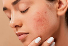 Catat! Ini Dia Rekomendasi Skincare Terbaik untuk Kulit Sunburn, Dijamin Kembali Normal!