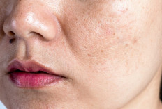 Kulit Wajah Sensitif Bikin Pusing, Yuk Intip Tips Perawatan yang Tepat dan Lengkapnya!