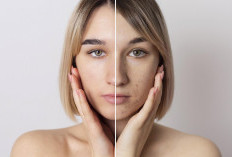 Pilih Skincare untuk Kulit Kombinasi Susah, Tips Ini Bisa Diikuti!