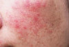 WAJIB DIINGAT! Jangan Gunakan Kandungan Skincare Ini Jika Kulit Iritasi