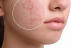 Bekas Jerawat Bikin Frustrasi, Ini Deretan Serum Ampuh yang Dapat Membasminya