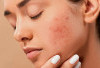 Catat! Ini Dia Rekomendasi Skincare Terbaik untuk Kulit Sunburn, Dijamin Kembali Normal!