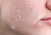 Waspada! Ternyata Ini Tanda Kulit Wajah Mengalami Over Exfoliation dan Tips Mengatasinya!